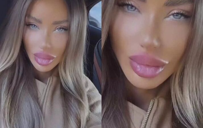 Bianca Drăgușanu transformare spectaculoasă la o lună de la operația de lifting facial de 11.000 de euro