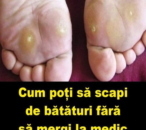 Cum poți să scapi de bătături fără să mergi la medic: Sigur nu știai acest remediu